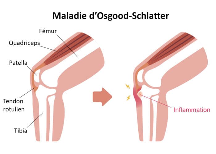 Maladie de croissance - Osgood Schlatter inflammation, ostéopathie